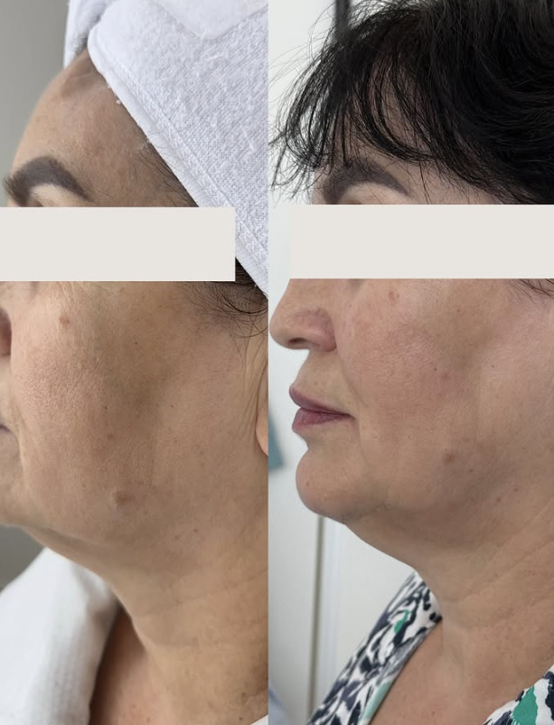 HIFU SMAS Lifting for Lifting and tightening on patient in dubai inskin aesthetic clinic