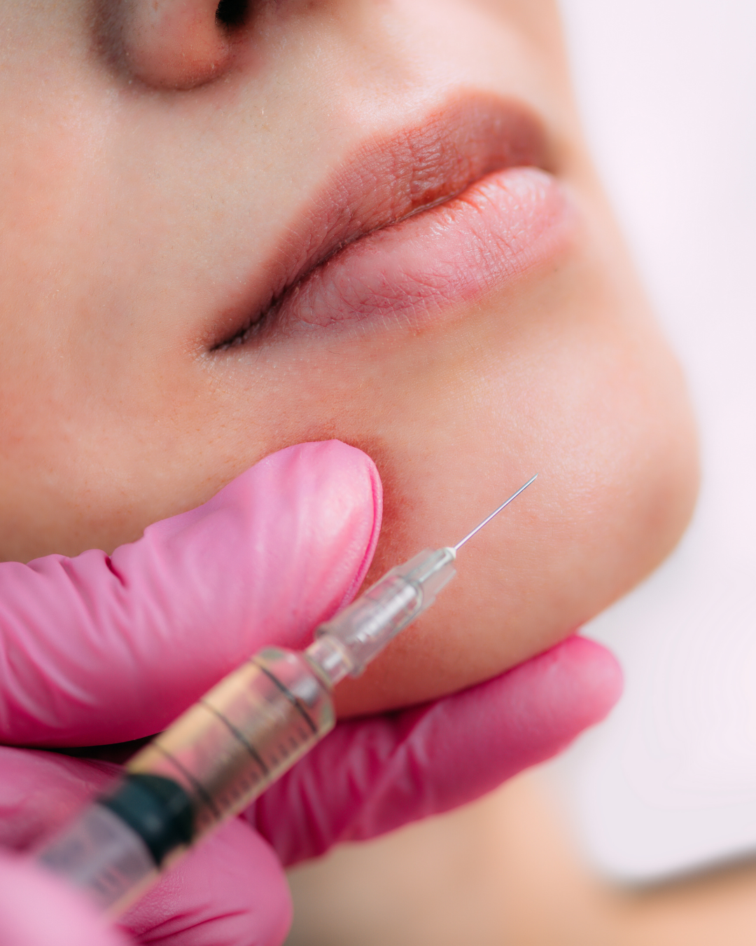 Dermal chin filler for enhancing chin projection and contouring in dubai