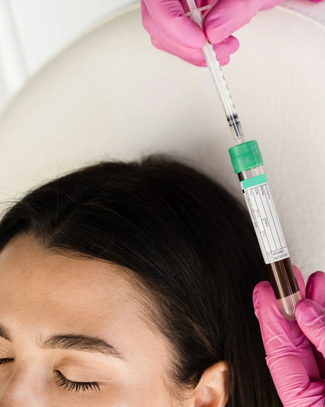 PRP treatment for Hair loss and hair fall in dubai.