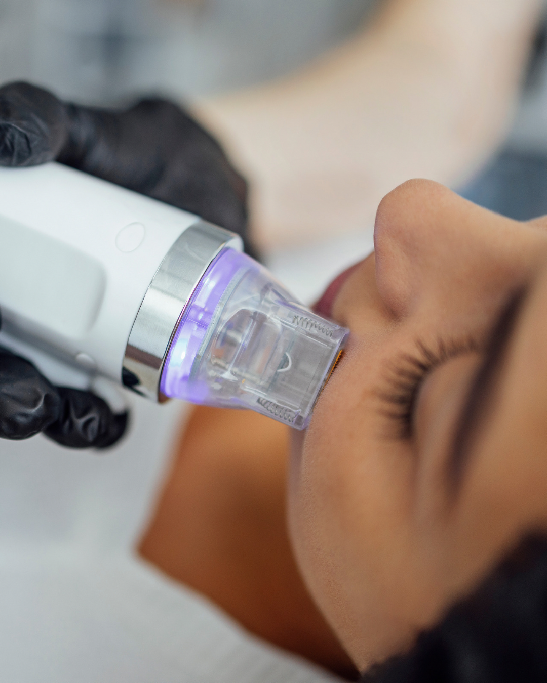 RF Microneedling on patient in dubai for face tightening and rejuvination.